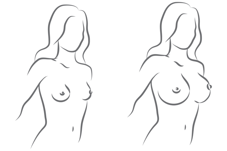 Brystforstørrelse med eget fett